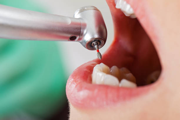 Best Emergency Wisdom Teeth Removal in Warren, OH
